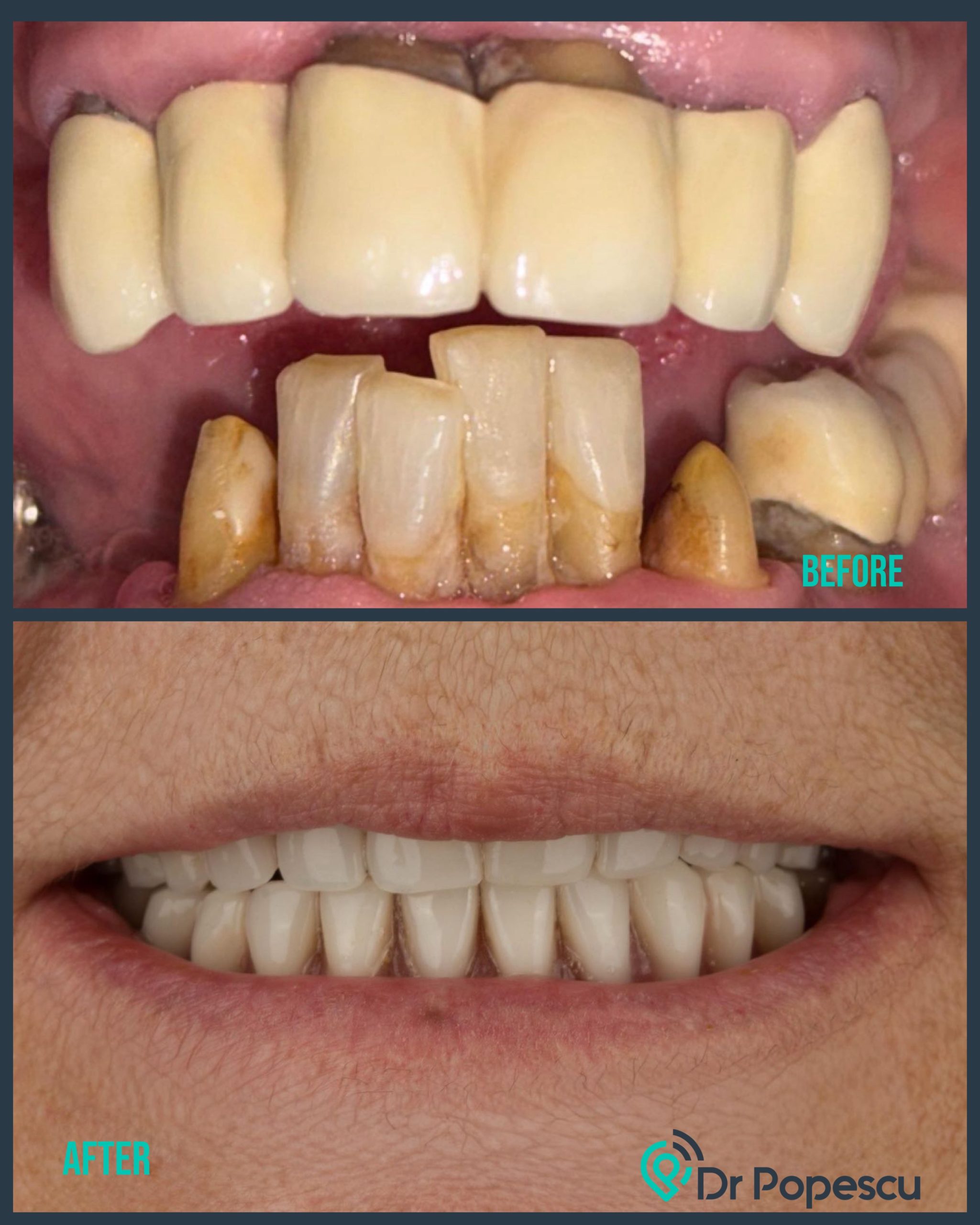 Before & After - Lucrare provizorie pentru pacienta noastră Primul pas a fost lucrarea provizorie superioară/inferioară funcțională, estetică, gândită să redea confortul și încrederea încă din primele zile. Urmează lucrarea definitivă în aproximativ 5 luni, unde rafinăm fiecare detaliu: formă, proporții, zâmbet. Pentru noi, procesul contează la fel de mult ca rezultatul final. Pentru că un zâmbet frumos nu se face în grabă, ci pas cu pas. 📍 Clinica Dr. Popescu, Sector 2, București 📞 Programări: 0722 474 795
