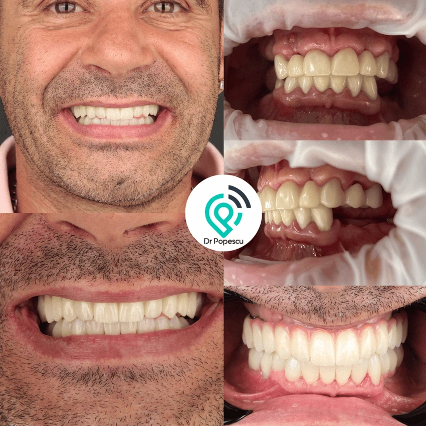 Rezultat înainte și după implant dentar - Clinica Dr Popescu