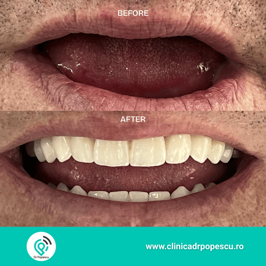 Rezultat înainte și după implant dentar - Clinica Dr Popescu