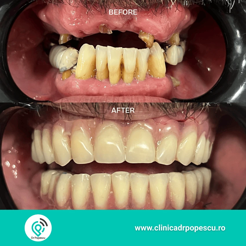 Rezultat înainte și după implant dentar - Clinica Dr Popescu