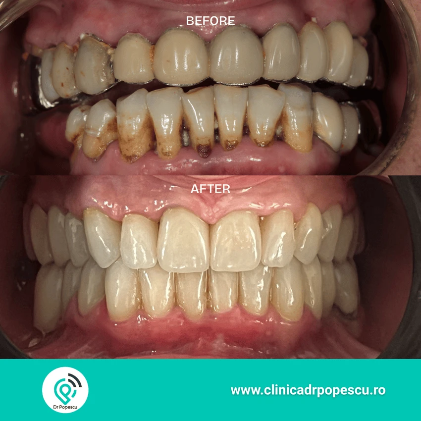 Rezultat înainte și după implant dentar - Clinica Dr Popescu