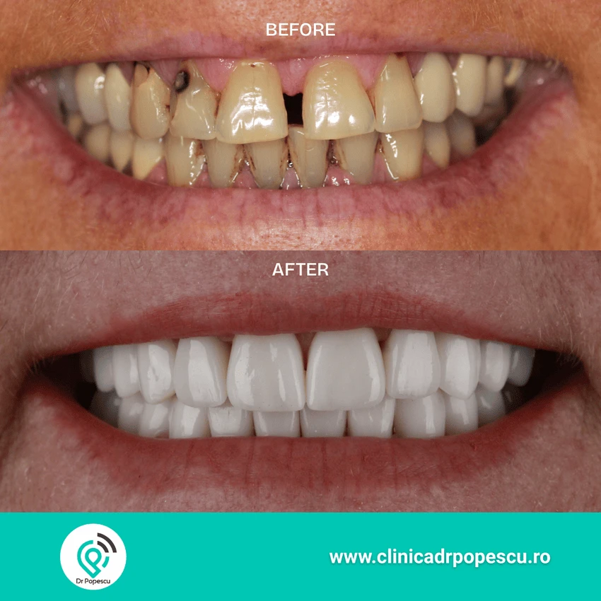 Rezultat înainte și după implant dentar - Clinica Dr Popescu