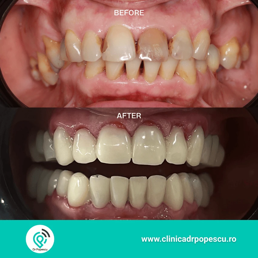 Rezultat înainte și după implant dentar - Clinica Dr Popescu