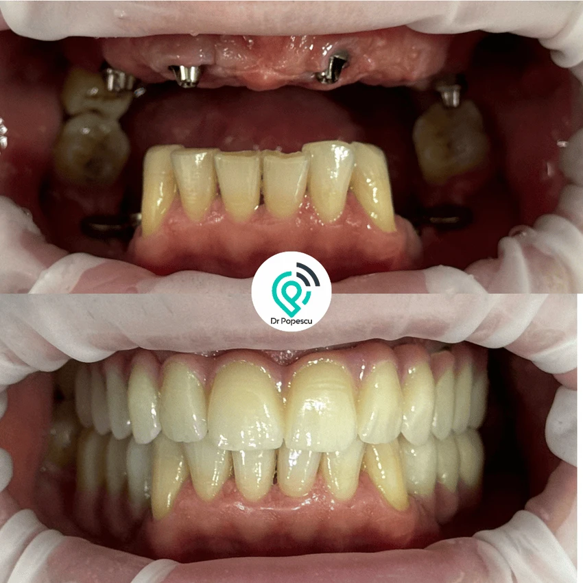 Rezultat înainte și după implant dentar - Clinica Dr Popescu