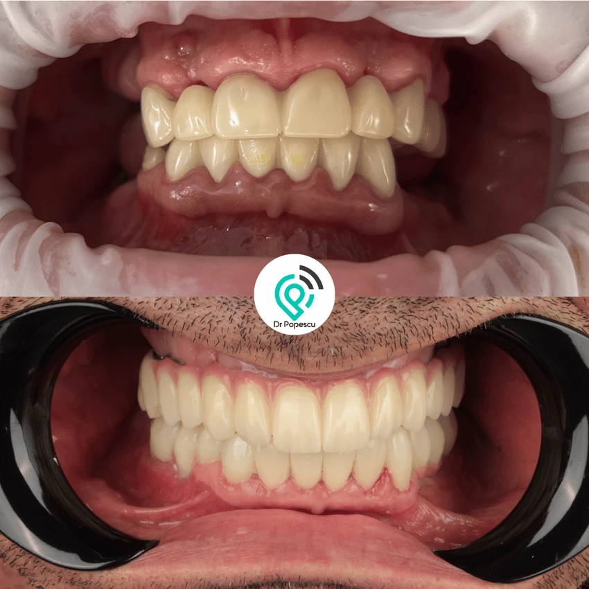 Rezultat înainte și după implant dentar - Clinica Dr Popescu