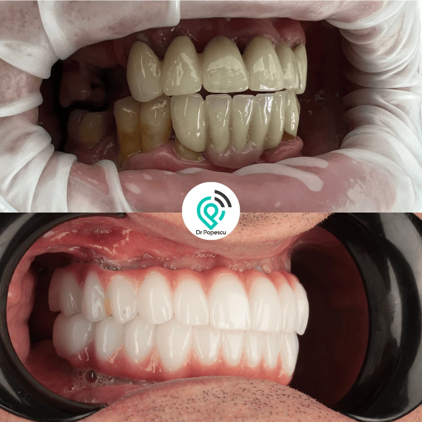 Rezultat înainte și după implant dentar - Clinica Dr Popescu