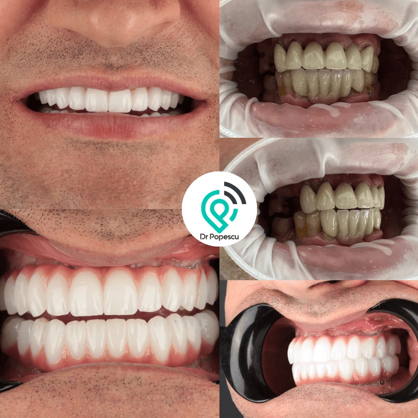 Rezultat înainte și după implant dentar - Clinica Dr Popescu