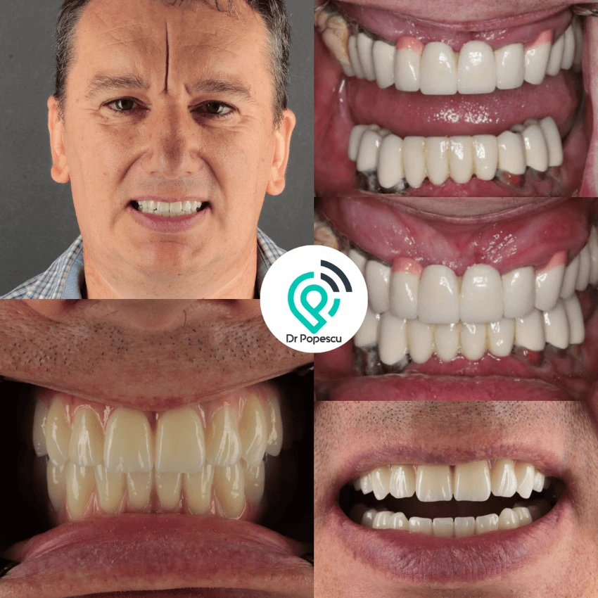 Rezultat înainte și după implant dentar - Clinica Dr Popescu